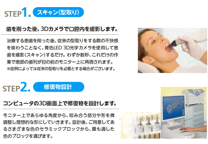 セレックシステム治療お流れSTEP1~STEP2