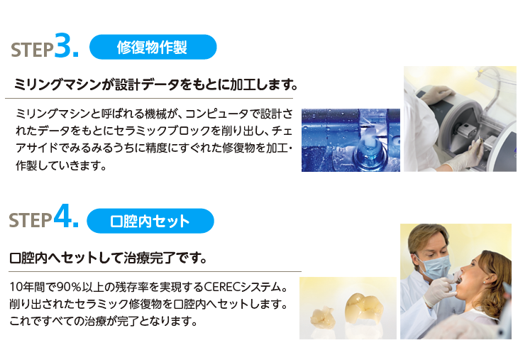 セレックシステム治療お流れSTEP3~STEP4