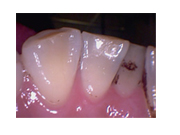 歯科用口腔内カメラでの治療2