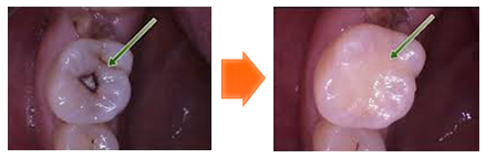 歯科用口腔内カメラでの治療1