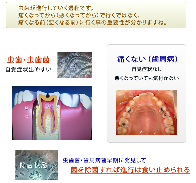 虫歯が進行していく過程